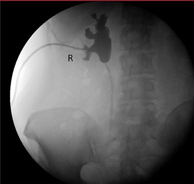 Total Intracorporeal Robot Kidney Autotransplantation: Case Report and Description of Surgical Technique